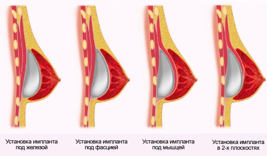 Импланты грудных желез
